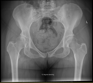 Give it to me straight, Doc. Will I ever peg again?